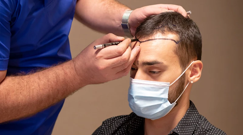 Preparing for a Hair Transplant Procedure