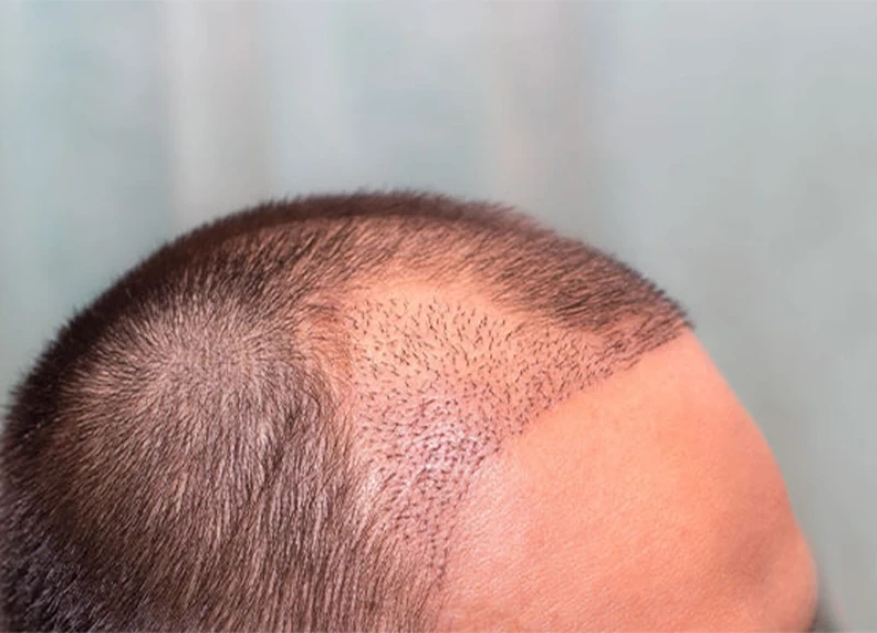 Cost of Hair Transplant in Antalya, Turkey