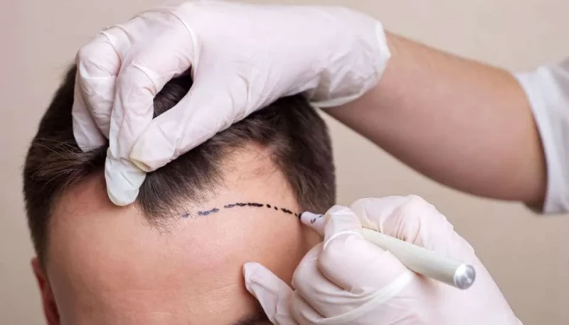 Understanding the Cost of Hair Transplant in Antalya, Turkey