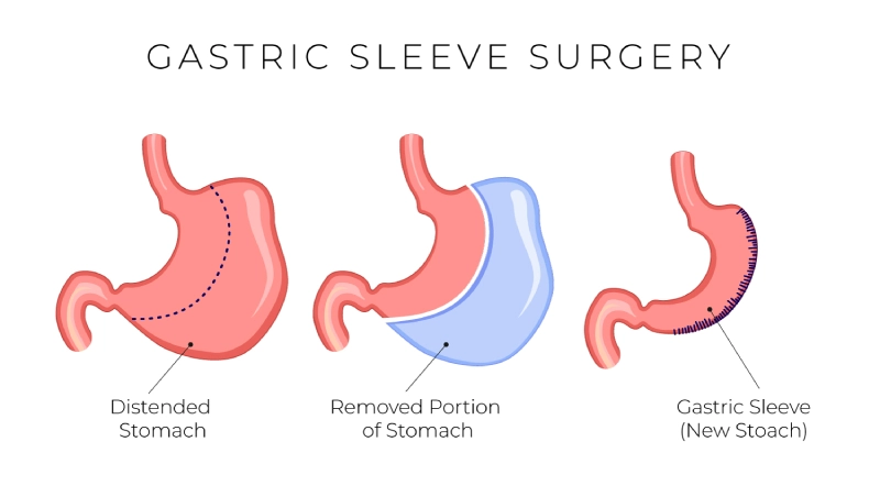 Qualification Criteria for Gastric Sleeve Surgery in Turkey