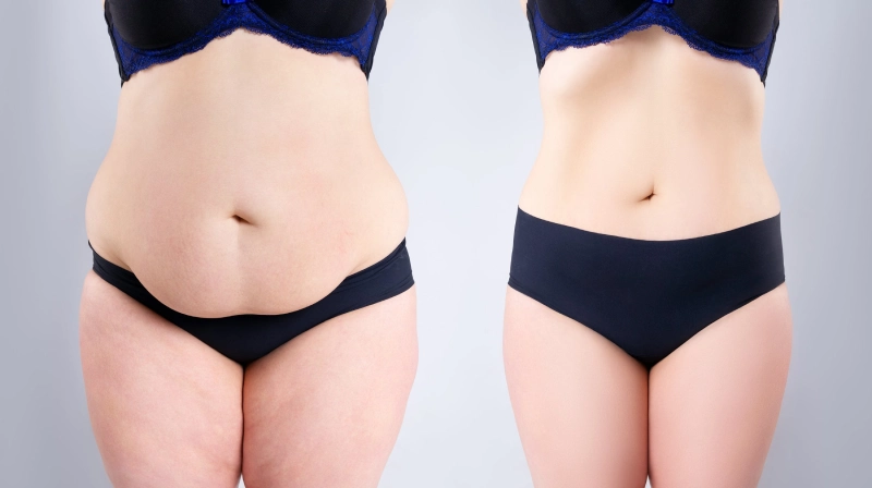 Benefits of Obesity Surgery in Antalya